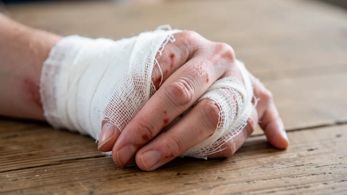 Imagen de primer plano de una mano con quemaduras leves, vendada.